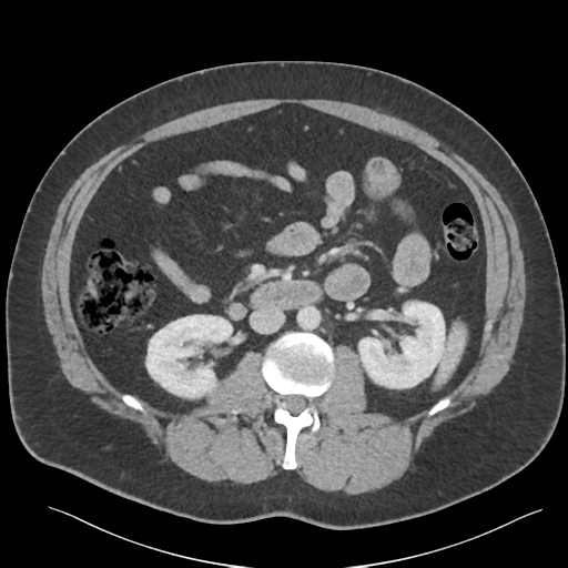 Adrenal cyst (Radiopaedia 45625-49777 Axial C+ portal venous phase 48).png