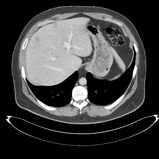 File:Adrenal cyst (Radiopaedia 45625-49778 AXIAL THICK 60 sec 1).png