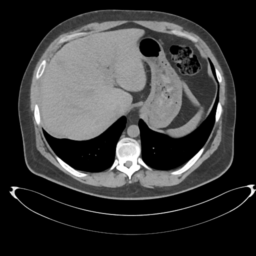 File:Adrenal cyst (Radiopaedia 45625-49778 Axial non-contrast 14).png