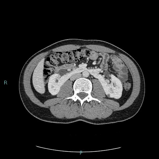 Adrenal cystic lymphangioma (Radiopaedia 83161-97534 Axial C+ portal venous phase 47).jpg