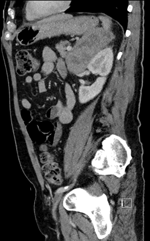 Adrenal lymphoma (Radiopaedia 73730-84529 Sagittal C+ portal venous phase 76).jpg