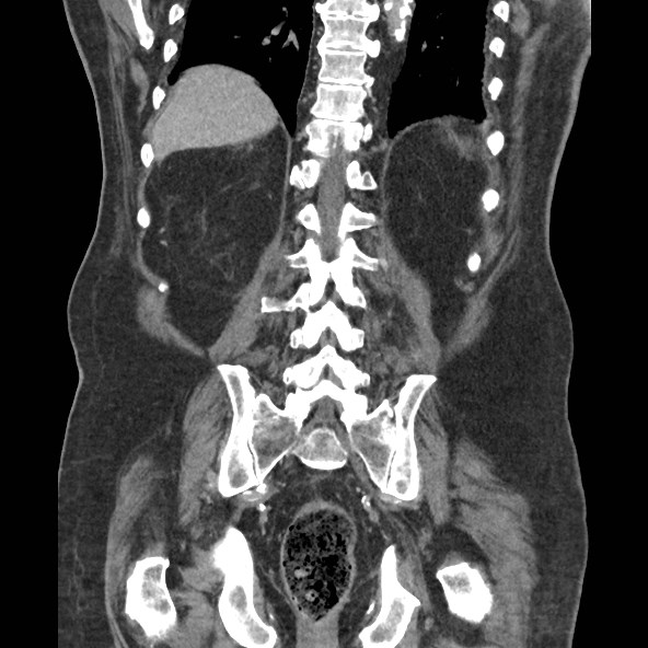 Adrenal lymphoma (Radiopaedia 84145-99415 Coronal C+ portal venous phase 69).jpg