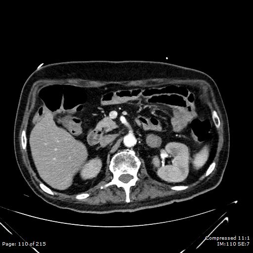 Adrenal metastasis (Radiopaedia 78425-91079 Axial C+ arterial phase 40).jpg