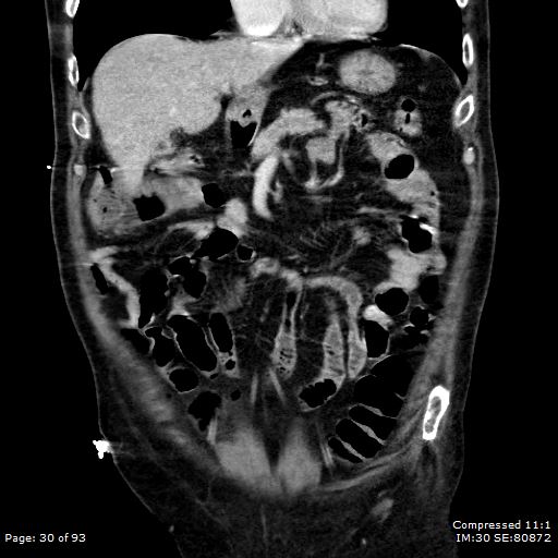 File:Adrenal metastasis (Radiopaedia 78425-91079 Sagittal C+ portal venous phase 17).jpg
