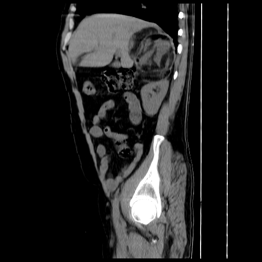 File:Adrenal myelolipoma (Radiopaedia 41843-44834 Sagittal non-contrast 9).jpg