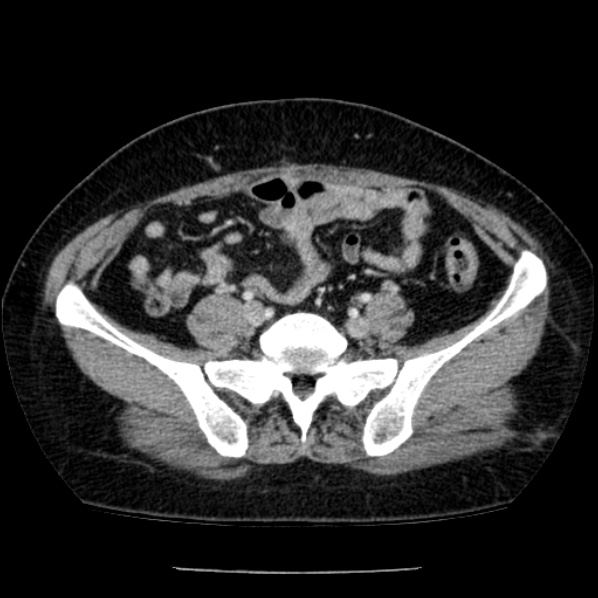Adrenal myelolipoma (Radiopaedia 43401-46759 Axial C+ portal venous phase 63).jpg
