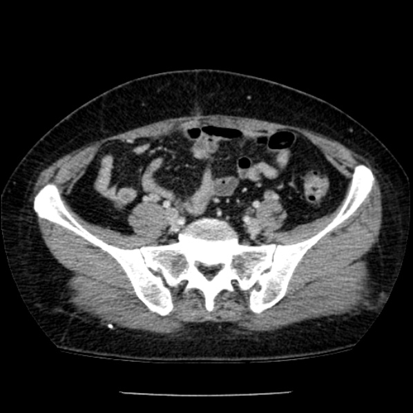 Adrenal myelolipoma (Radiopaedia 43401-46759 Axial C+ portal venous phase 65).jpg