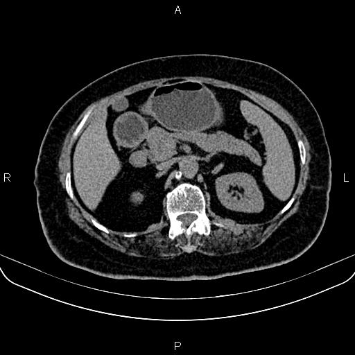 Adrenal myelolipoma (Radiopaedia 82742-96986 Axial non-contrast 54).jpg