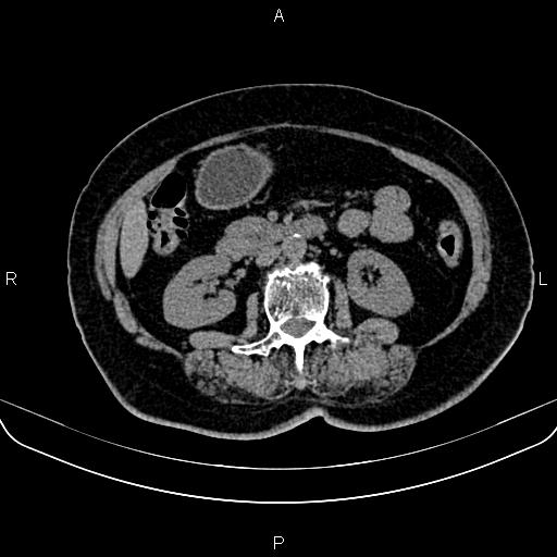 Adrenal myelolipoma (Radiopaedia 82742-96986 Axial non-contrast 74).jpg