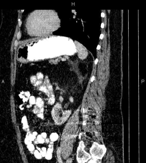 Adrenal myelolipoma (Radiopaedia 84319-99617 Sagittal renal cortical phase 65).jpg