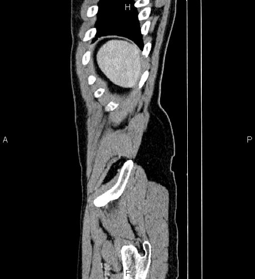 Adrenal myelolipoma (Radiopaedia 87794-104246 Sagittal renal cortical phase 89).jpg