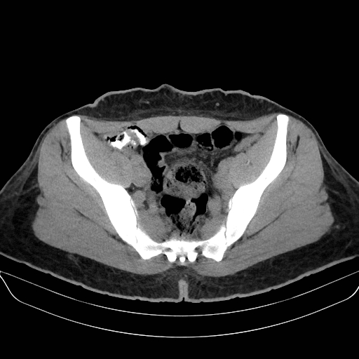 File:Adrenal myelolipoma - bilateral (Radiopaedia 74805-85810 Axial non-contrast 67).jpg