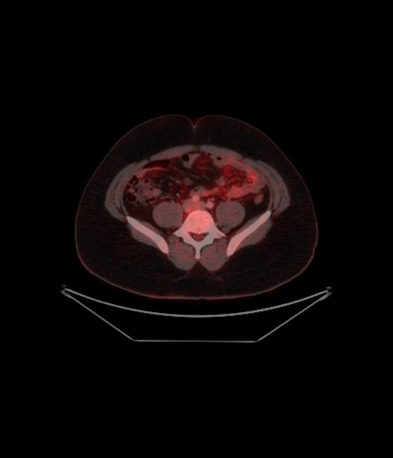 Adrenocortical carcinoma (Radiopaedia 80134-93440 ِAxial 210).jpg