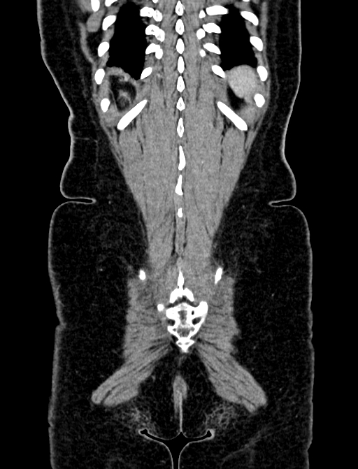 Adrenocortical carcinoma (Radiopaedia 87281-103569 Coronal C+ portal venous phase 142).jpg