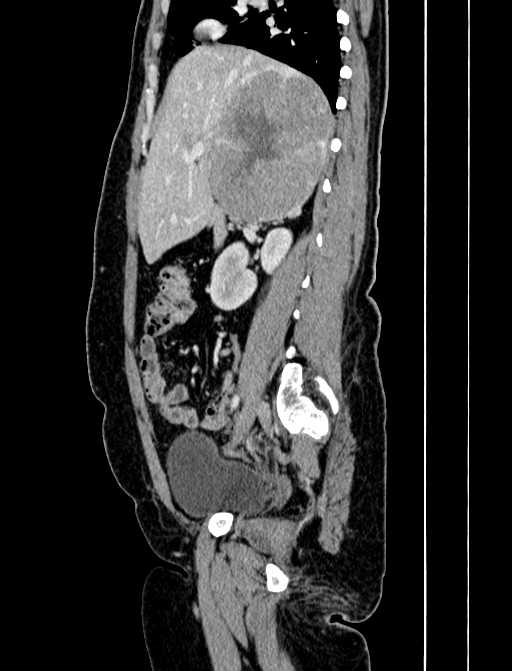 Adrenocortical carcinoma (Radiopaedia 87281-103569 Sagittal C+ portal venous phase 101).jpg