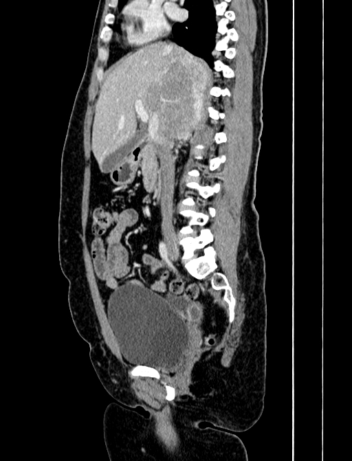 Adrenocortical carcinoma (Radiopaedia 87281-103569 Sagittal C+ portal venous phase 122).jpg