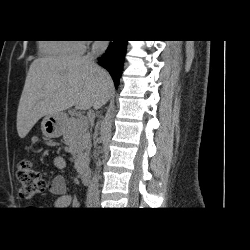 Adult polycystic kidney disease (Radiopaedia 59075-66368 Sagittal non-contrast 39).jpg