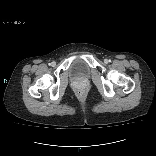 Adult transient intestinal intussusception (Radiopaedia 34853-36310 Axial C+ portal venous phase 121).jpg