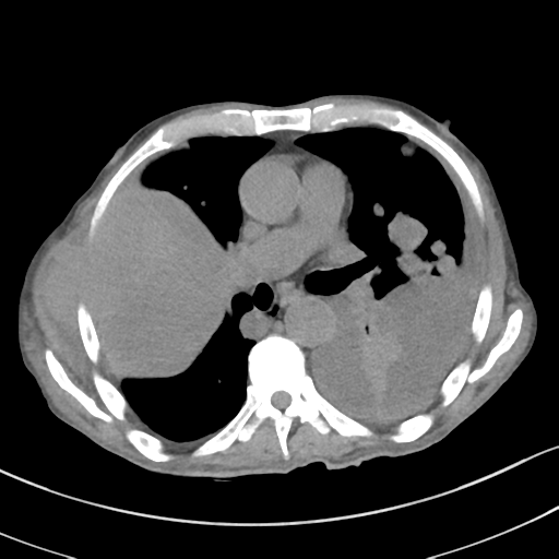 Advanced metastatic lung cancer (Radiopaedia 48910-53954 Axial non-contrast 32).png