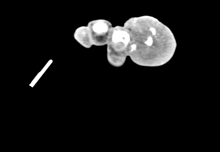 Advanced osteomyelitis due to open metatarsal fracture (Radiopaedia 83891-99095 Axial non-contrast 52).jpg