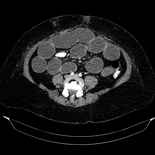 Afferent loop syndrome - secondary to incarcerated trocar site hernia (Radiopaedia 82959-97305 Axial C+ portal venous phase 154).jpg