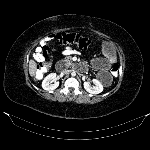 Afferent loop syndrome - secondary to incarcerated trocar site hernia (Radiopaedia 82959-97305 Axial C+ portal venous phase 97).jpg