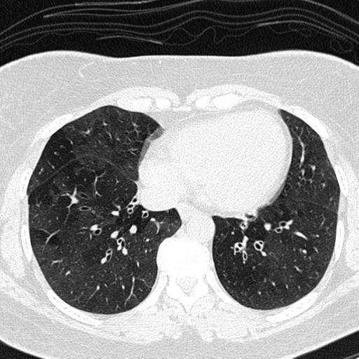 File:Air trapping in small airway disease (Radiopaedia 61685-69694 Axial lung window 123).jpg