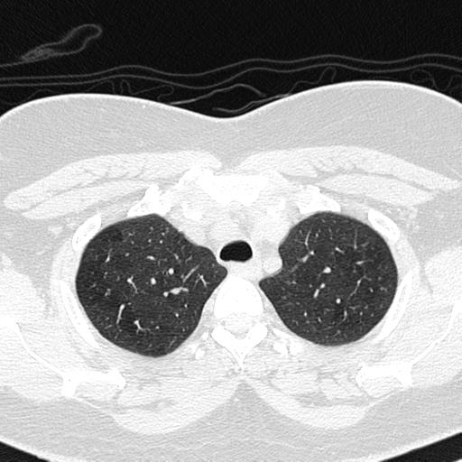 Air trapping in small airway disease (Radiopaedia 61685-69694 Axial lung window 32).jpg