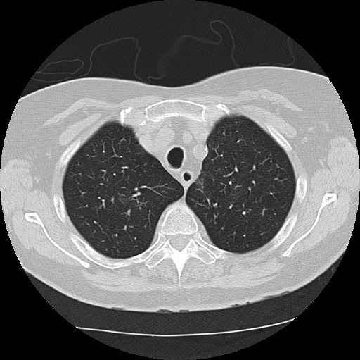 Alpha-1-antitrypsin deficiency (Radiopaedia 72058-82557 Axial lung window 13).jpg
