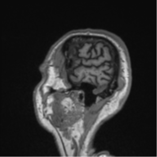 Alzheimer's disease- with Gerstmann syndrome and dressing apraxia (Radiopaedia 54882-61150 Sagittal T1 65).png