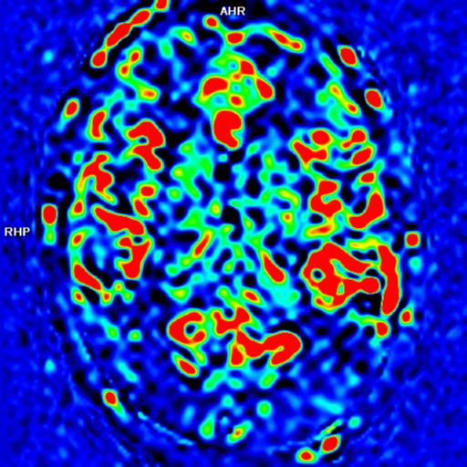 File:Alzheimer's disease- with apraxia (Radiopaedia 54763-61011 E 23).png