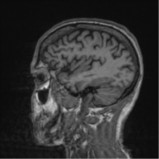 File:Alzheimer's disease- with apraxia (Radiopaedia 54763-61011 Sagittal T1 17).png