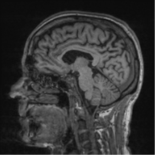 File:Alzheimer's disease- with apraxia (Radiopaedia 54763-61011 Sagittal T1 39).png