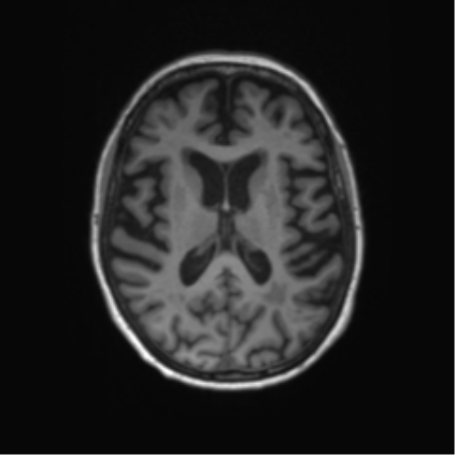 Alzheimer's disease (Radiopaedia 42658-45802 Axial T1 71).png