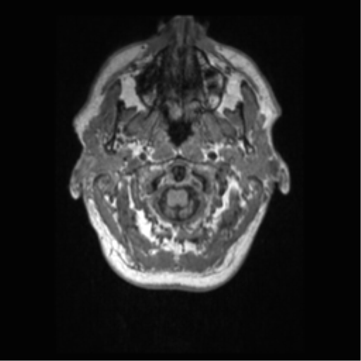 Alzheimer disease - probable (Radiopaedia 35334-36837 Axial T1 7).png