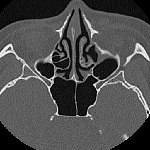 File:Ameloblastic fibro-odontoma (Radiopaedia 18843-18780 C 1).jpg