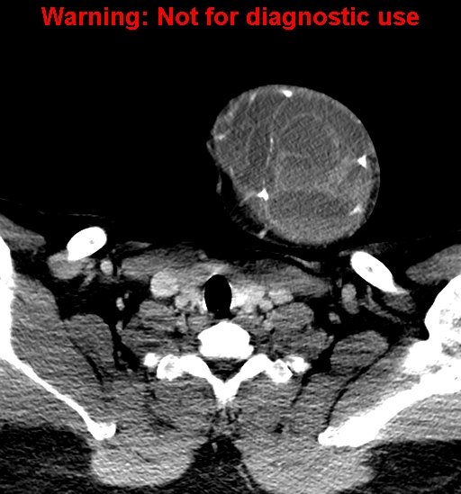 File:Ameloblastoma (Radiopaedia 33126-34164 B 36).jpg