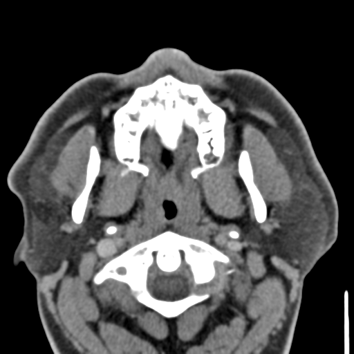 File:Ameloblastoma (Radiopaedia 33677-34806 Axial non-contrast 12).png