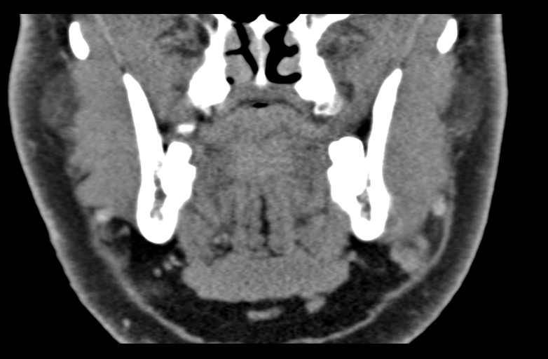 File:Ameloblastoma (Radiopaedia 33677-34806 Coronal non-contrast 29).png