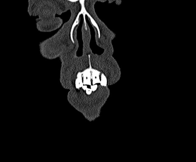 Ameloblastoma (Radiopaedia 51921-57766 Coronal bone window 6).jpg