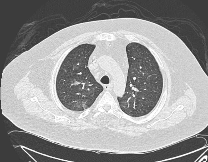 Amiodarone lung (Radiopaedia 62514-70769 Axial lung window 26).jpg