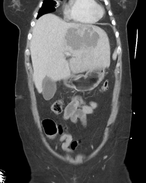 Amoebic liver abscess (Radiopaedia 52611-58530 B 19).png