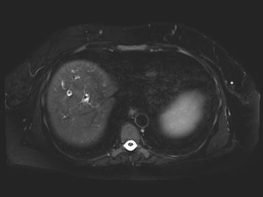 Ampullary adenocarcinoma (Radiopaedia 54765-61014 Axial T2 space-FS 9).jpg