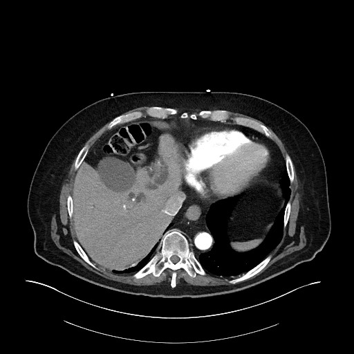 Ampullary adenocarcinoma (Radiopaedia 59373-66734 A 34).jpg