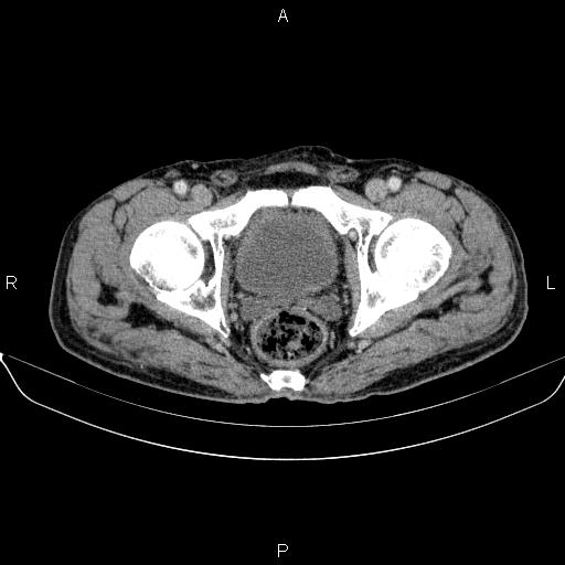 Ampullary adenocarcinoma (Radiopaedia 86093-102032 A 54).jpg