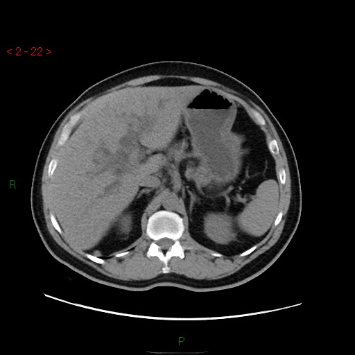 File:Ampullary carcinoma (Radiopaedia 56396-63056 Axial non-contrast 15).jpg
