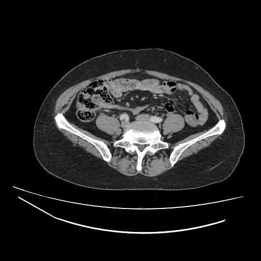 File:Ampullary tumor (Radiopaedia 60333-67998 A 59).jpg