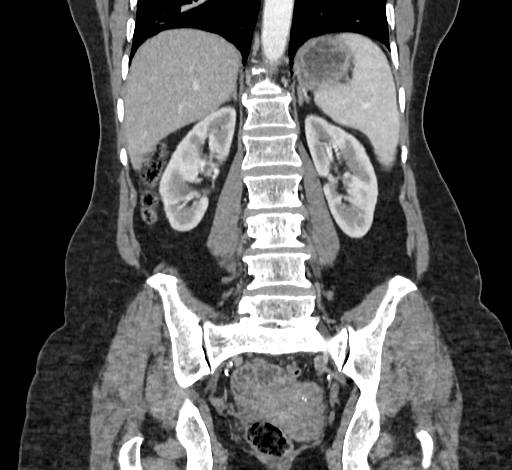 Ampullary tumor (Radiopaedia 60333-67998 B 53).jpg