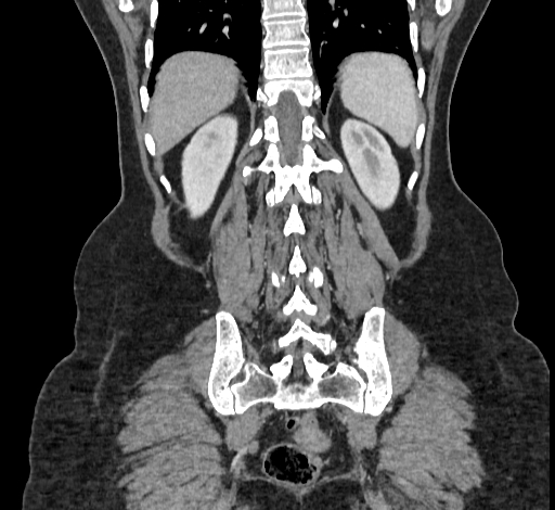 Ampullary tumor (Radiopaedia 60333-67998 B 64).jpg