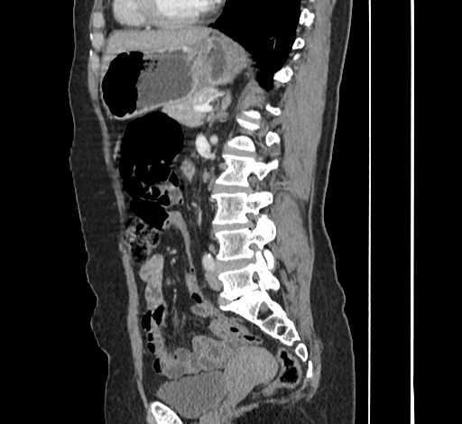 File:Ampullary tumor (Radiopaedia 60333-67998 C 35).jpg